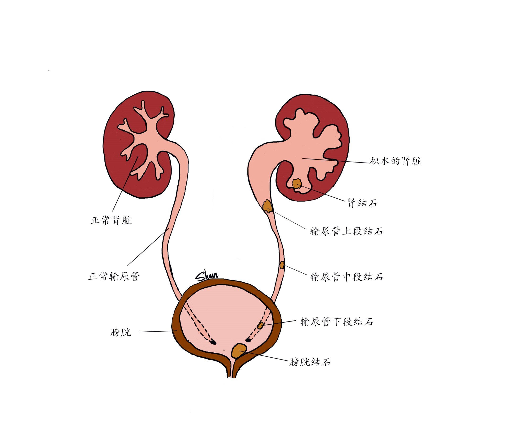 尿路结石.jpg