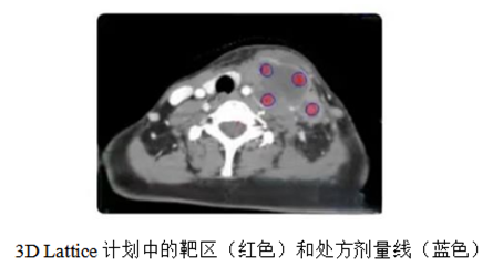 空间分割放疗（spatially fractionated radiation，SFRT）概述 - 好大夫在线