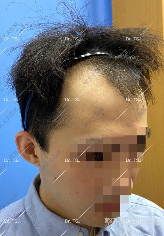 26岁男性脱发患者,自诉发际线双侧额角后移4年余