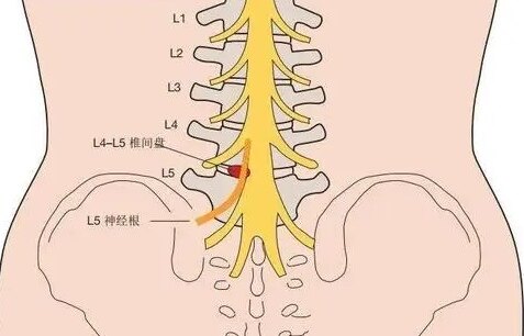 骶骨疼痛的原因有哪些?_疼痛_疼痛相关疾病 - 好大夫在线