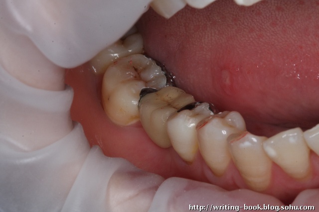 下后牙粘接桥一例 - 好大夫在线