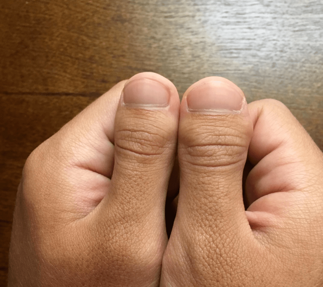 为什么你的拇指又宽又短 隐藏在 D型 短指 背后的遗传学秘密 短指症 短指症发病原因 好大夫在线 为什么你的拇指又宽又短 隐藏在 D型 短指 背后的遗传学秘密 短指症 短指症发病原因 好大夫在线