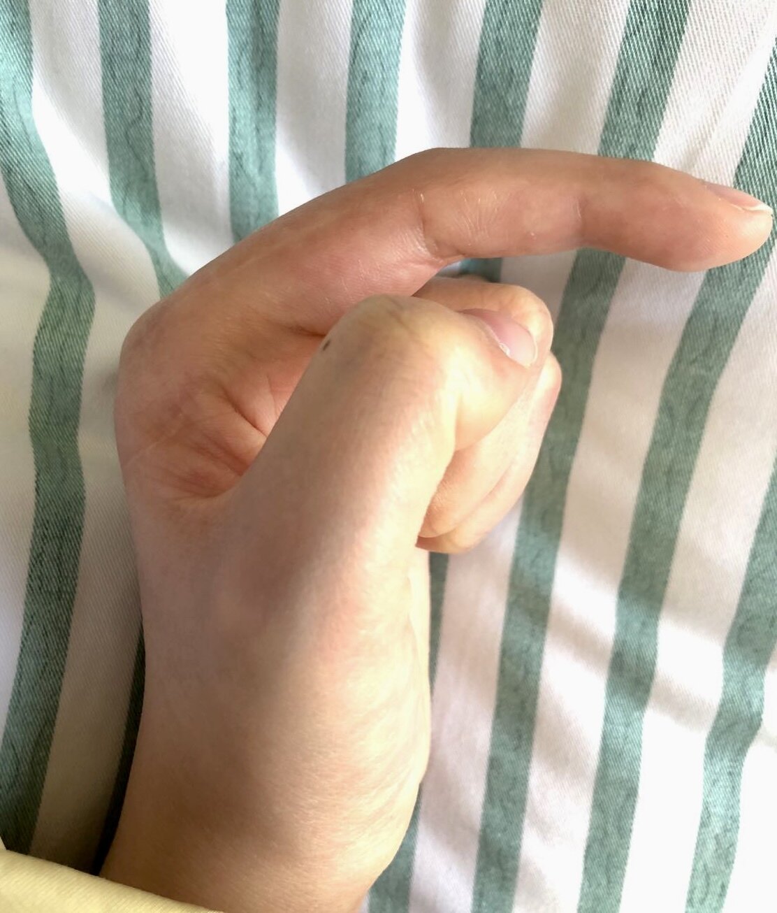 手部无人区2区屈指肌腱粘连