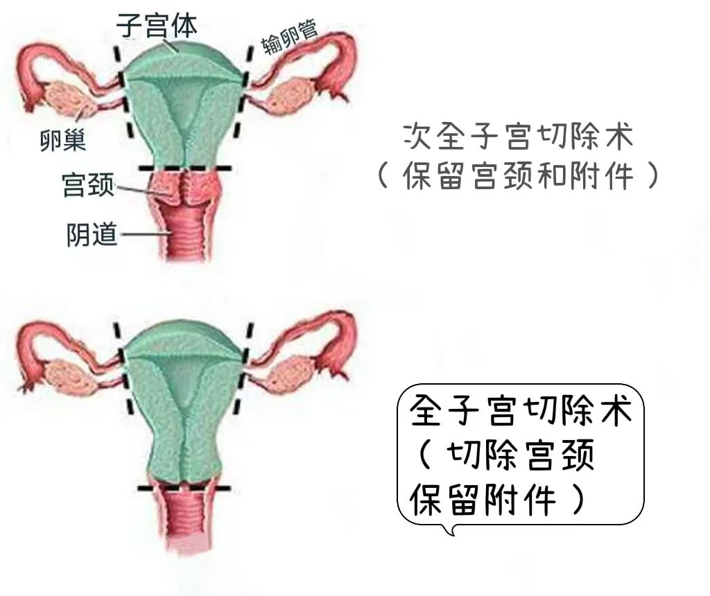 子宫切除能做微创手术吗?_子宫切除术_子宫切除术治疗介绍 - 好大夫在线