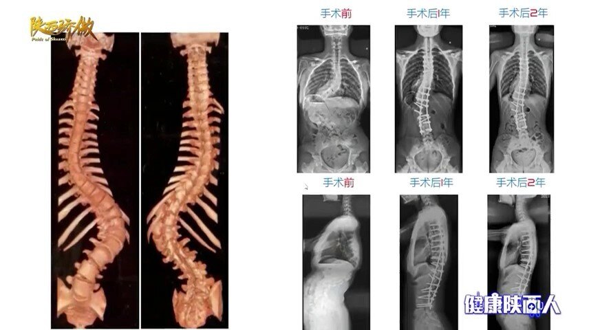 尾椎骨侧弯图片