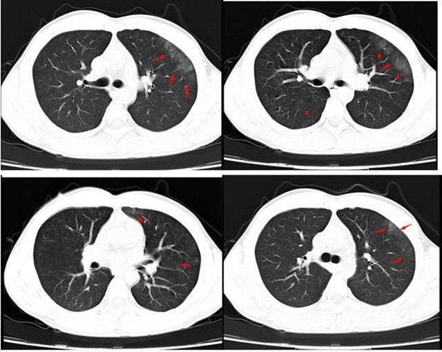 创伤性湿肺(肺挫伤)_肺部疾病_肺部疾病相关疾病 - 好大夫在线