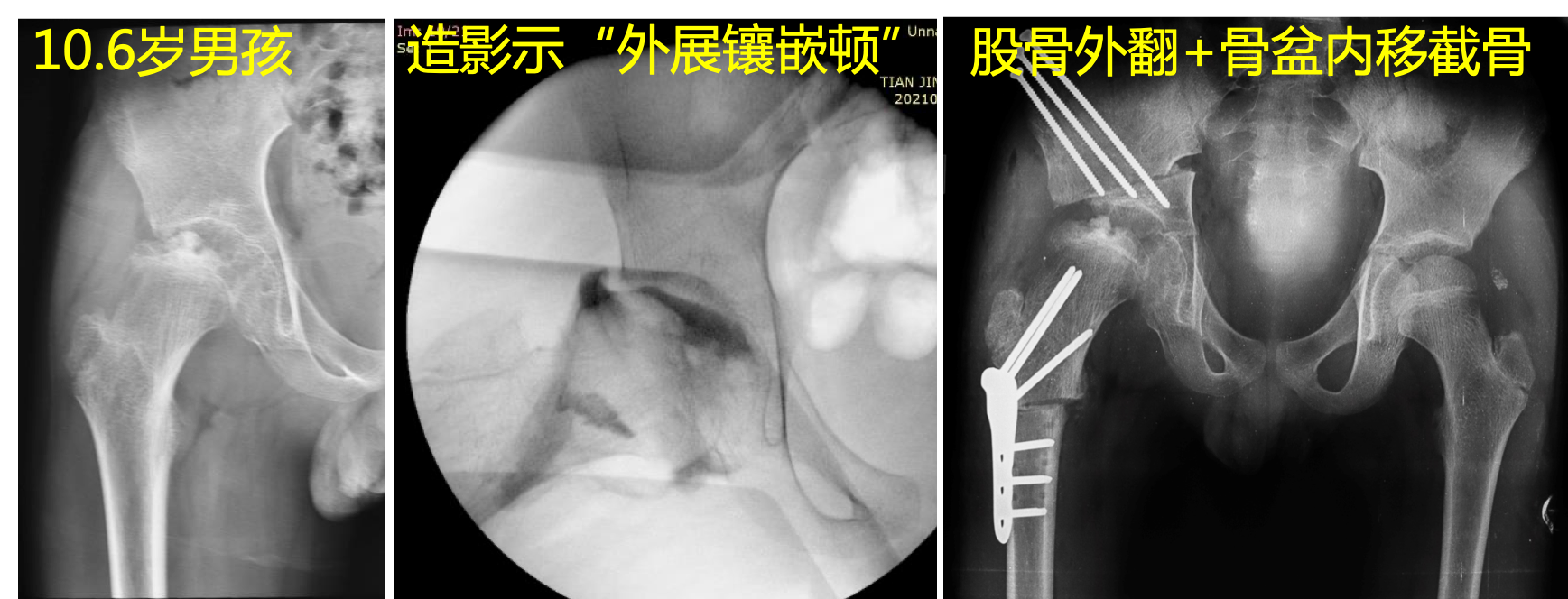 perthes 病科普系列之八:儿童创伤后股骨头坏死还能保髋吗?