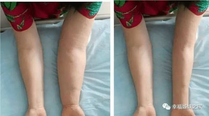 乳腺癌术后上肢水肿,胳膊抬不起?应该如何治疗? - 好大夫在线