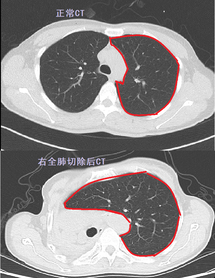 正常肺对比肺癌ct图片图片