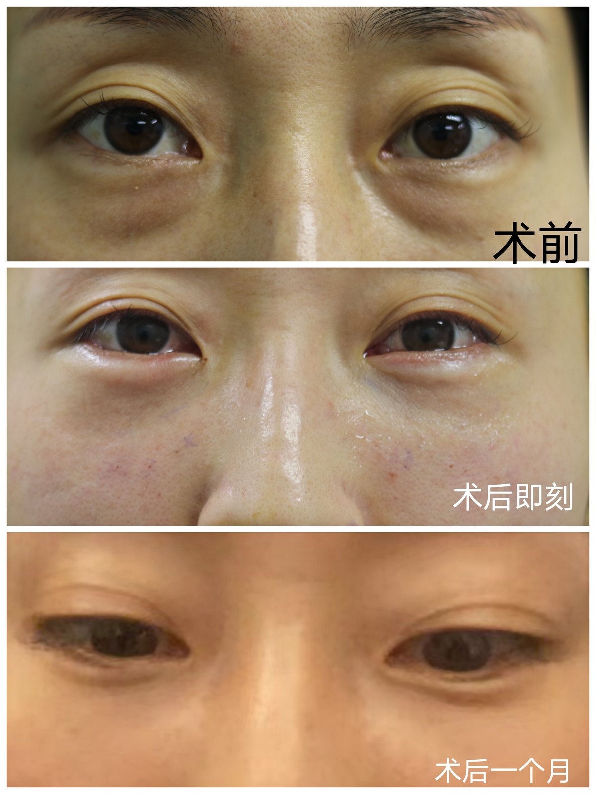 继续查看该图片可能引起不适内切眼袋眶隔释放手术对比图继续查看该