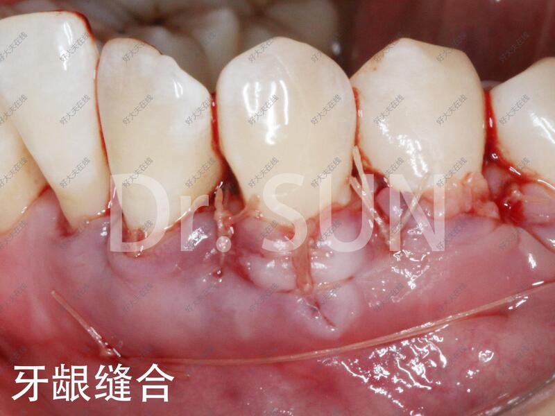 牙龈假膜图片