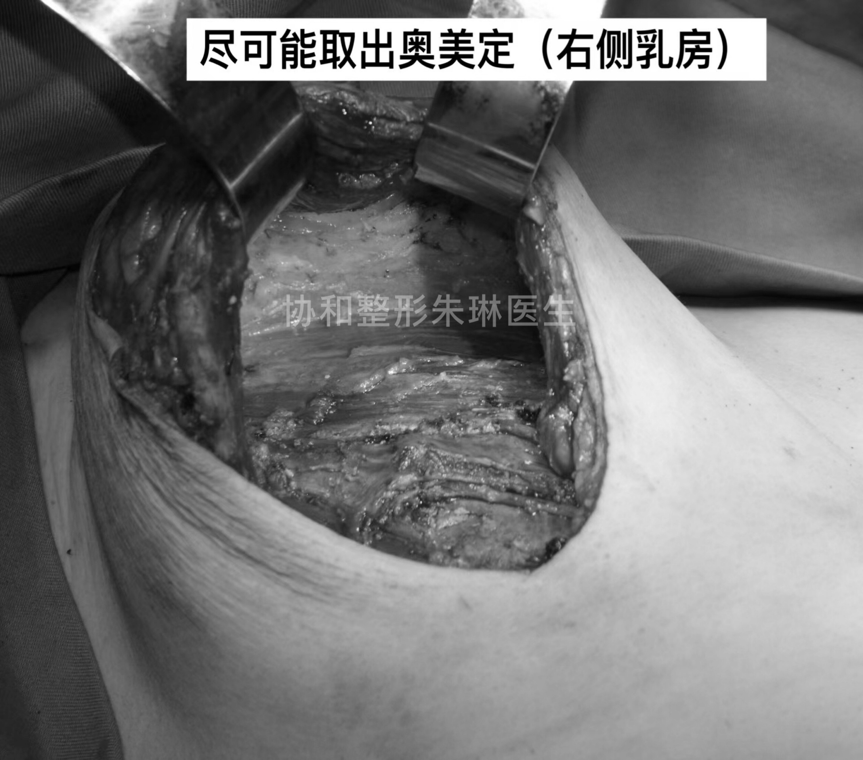 奥美定取出以后,胸部只能变得下垂吗?