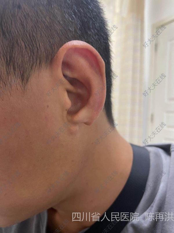 耳垂裂_耳疾病 - 好大夫在线
