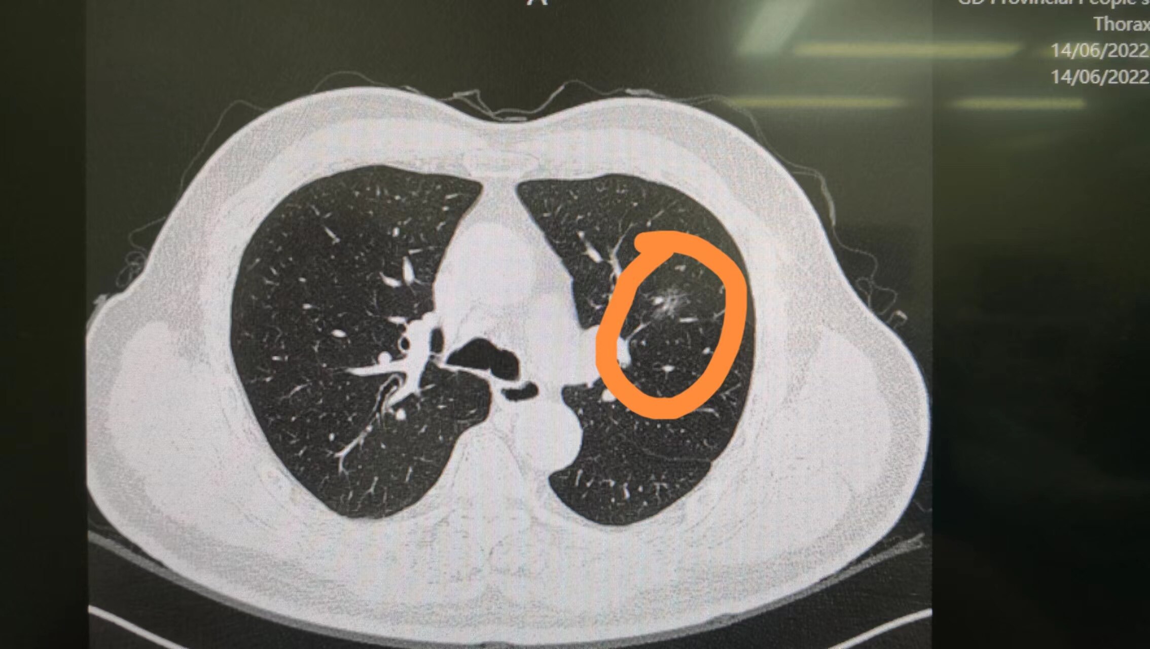 肺部纯磨玻璃结节图片