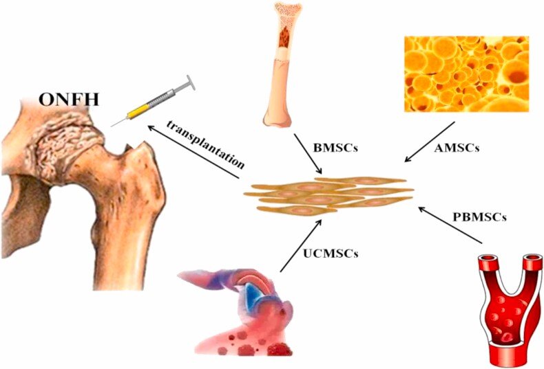 onfh: osteonecrosis of the femoral head.