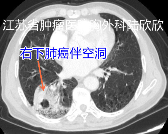 空洞型肿瘤伴肺炎 - 副本.jpg