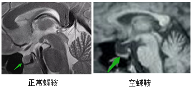 什么是空蝶鞍或空泡蝶鞍? ---手绘示意图,读完明明白白 - 好大夫在线