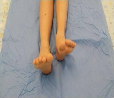 不等长(图5-1):因为假体不是专门定制的,加上个体上的解剖差异(髋内翻