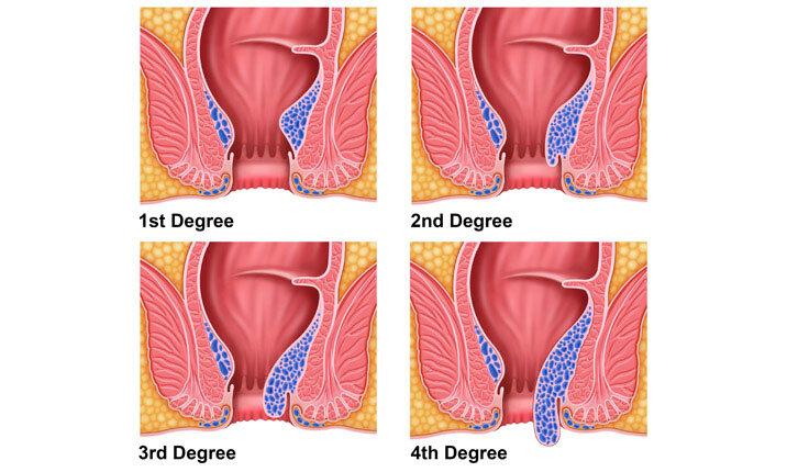 haemorrhoid-piles-degree-symptoms.jpg