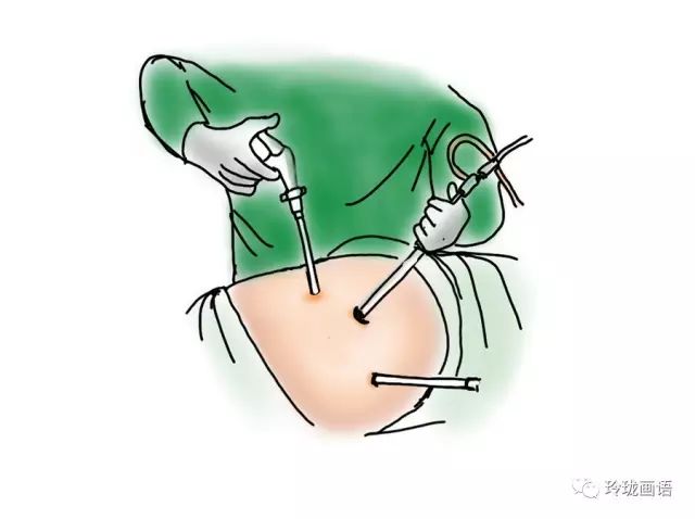 腹腔镜下卵巢打孔术对于lh和游离雄激素升高的pcos患者效果较好,能