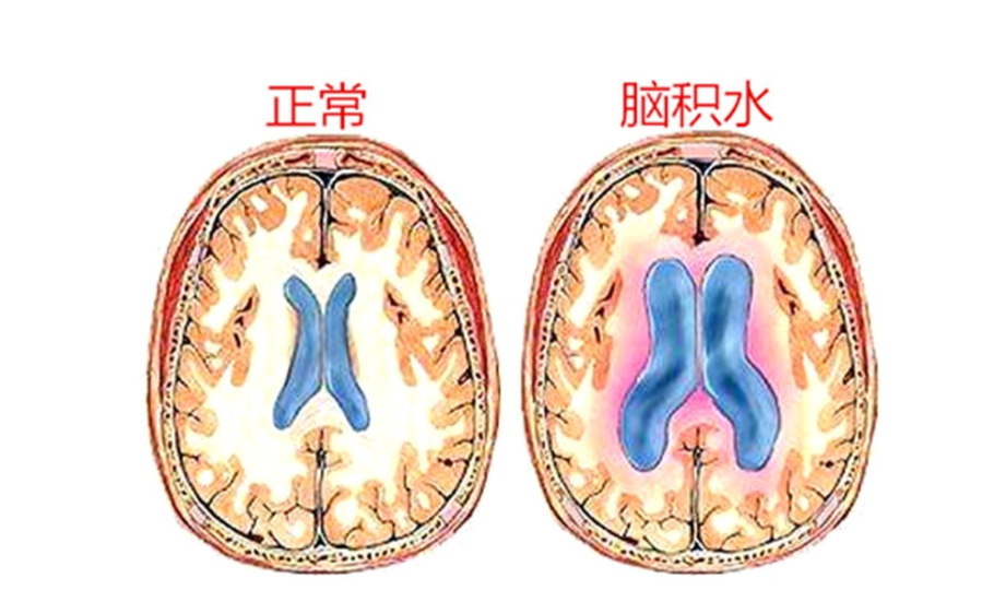 先天性脑积水患者这一路是怎么走过来的?