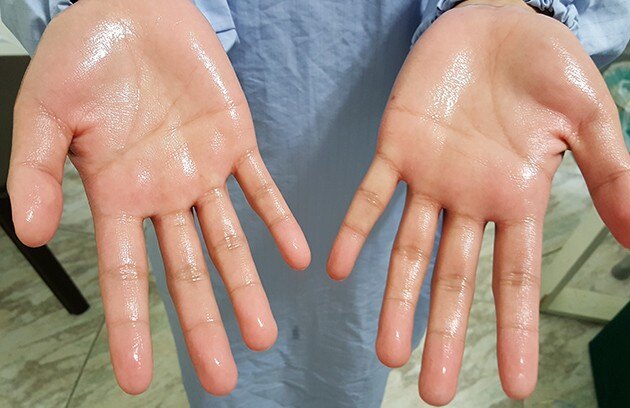 手汗症_介绍_发病原因_症状表现_治疗方式 - 好大夫在线