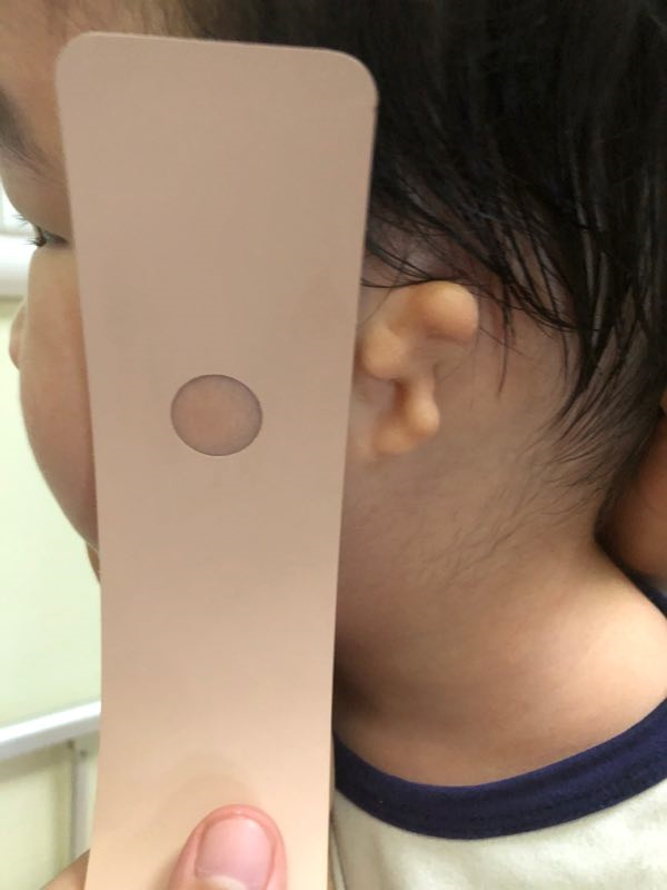 5d硅胶义耳,塑造不一样的人生_小耳畸形_治疗方式_治疗介绍 - 好大夫