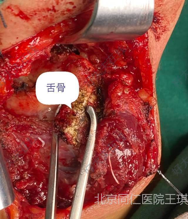 甲状舌管 手术图片