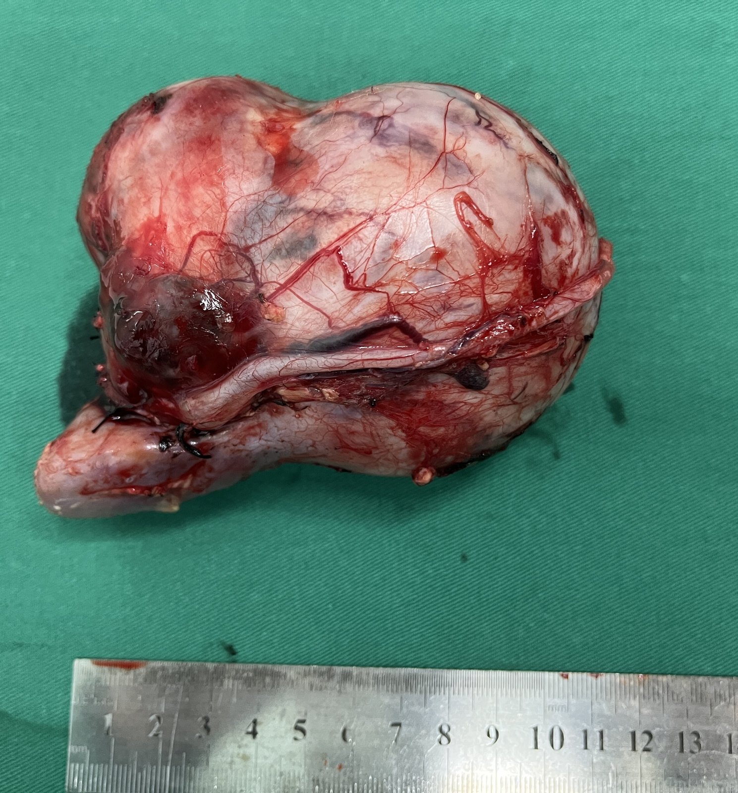 肾母细胞瘤切除术_肾母细胞瘤_肾母细胞瘤治疗方式 - 好大夫在线