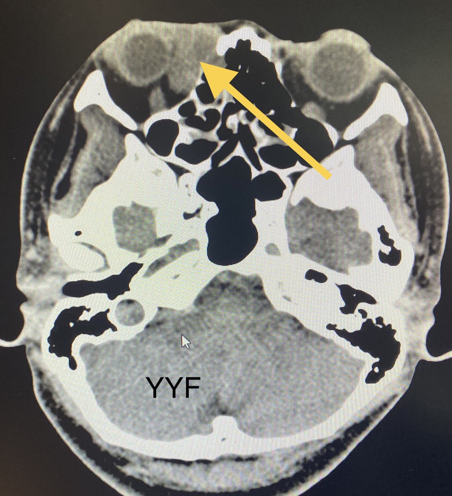 肿物位于泪囊区,有"炎症"表现,又是女性患者(泪道阻塞性疾病女性更好