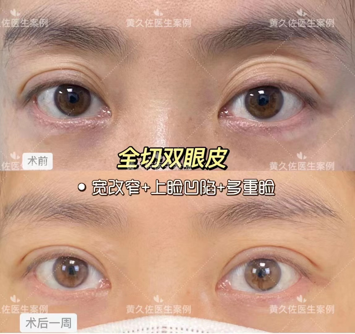 改变眼周衰老,我们能做些什么? - 好大夫在线