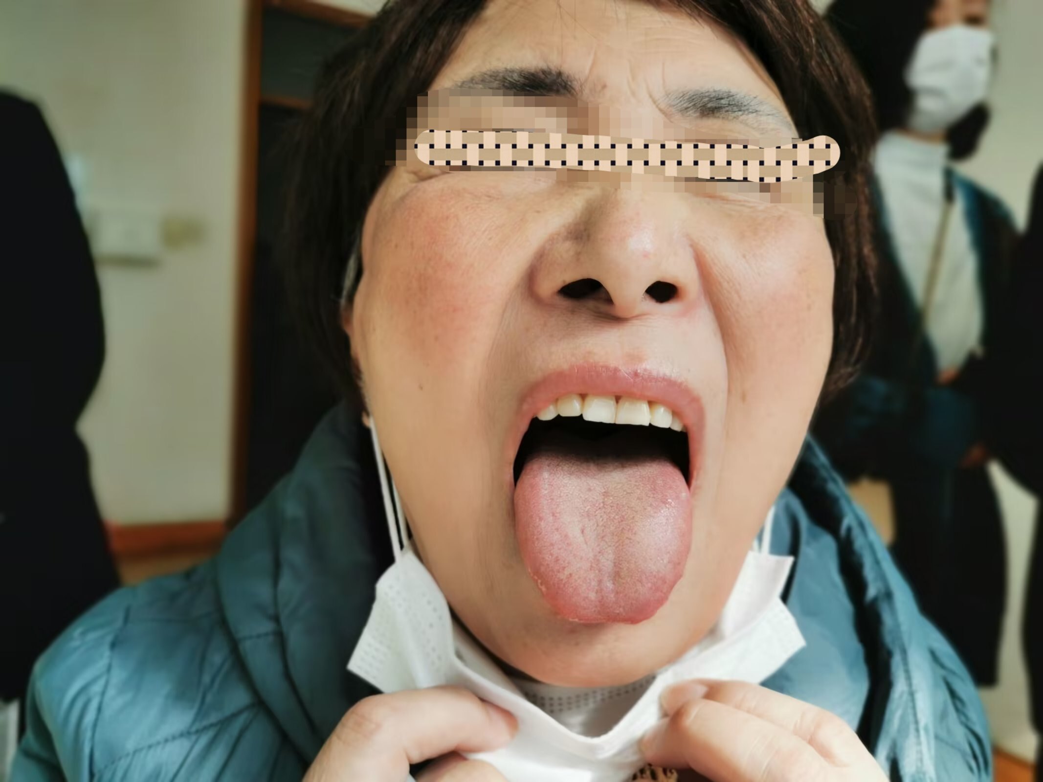 疫情后遗症有哪些症状表现呢图片和视频讲解下载(打疫苗后遗症的表现)