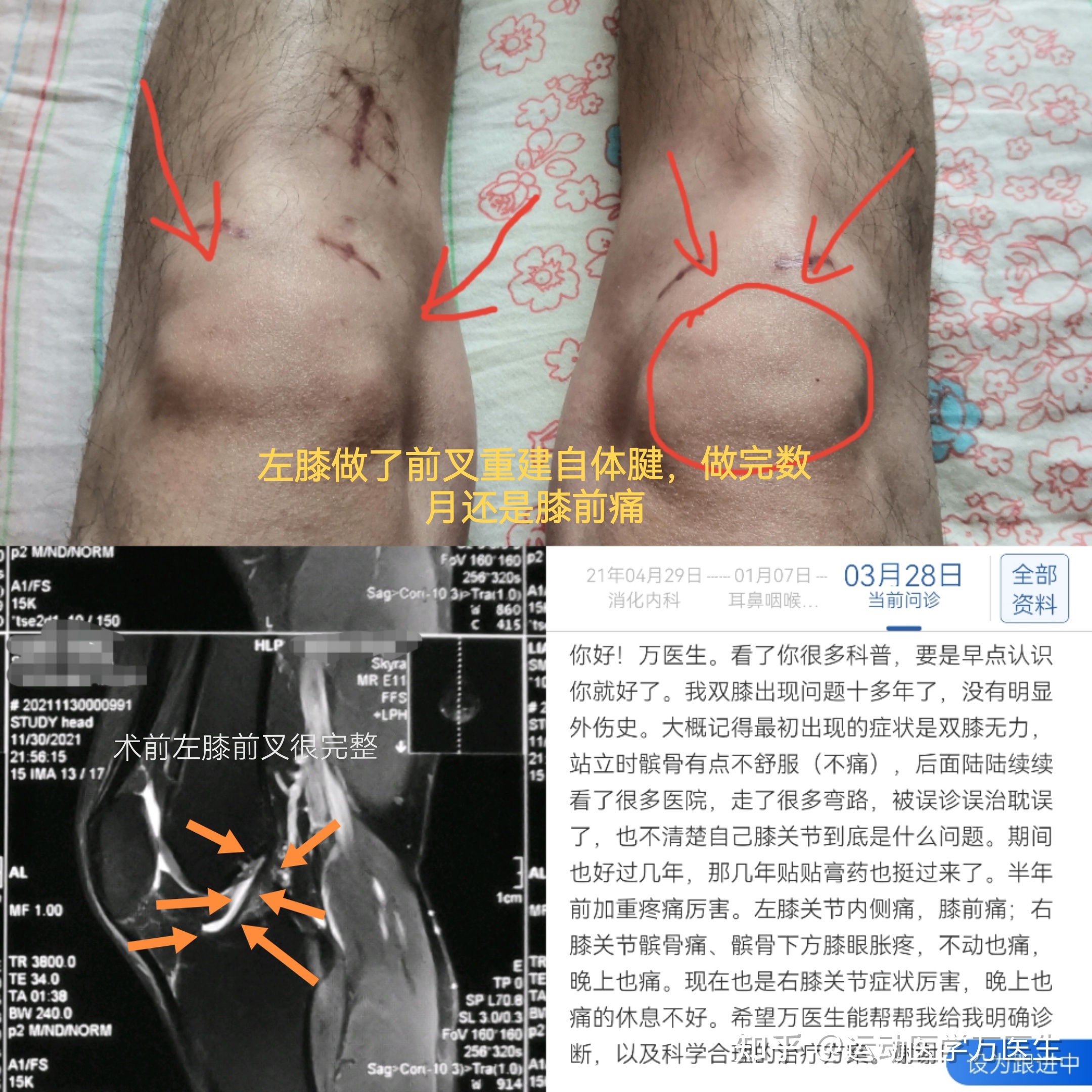 十字韧带疼图片