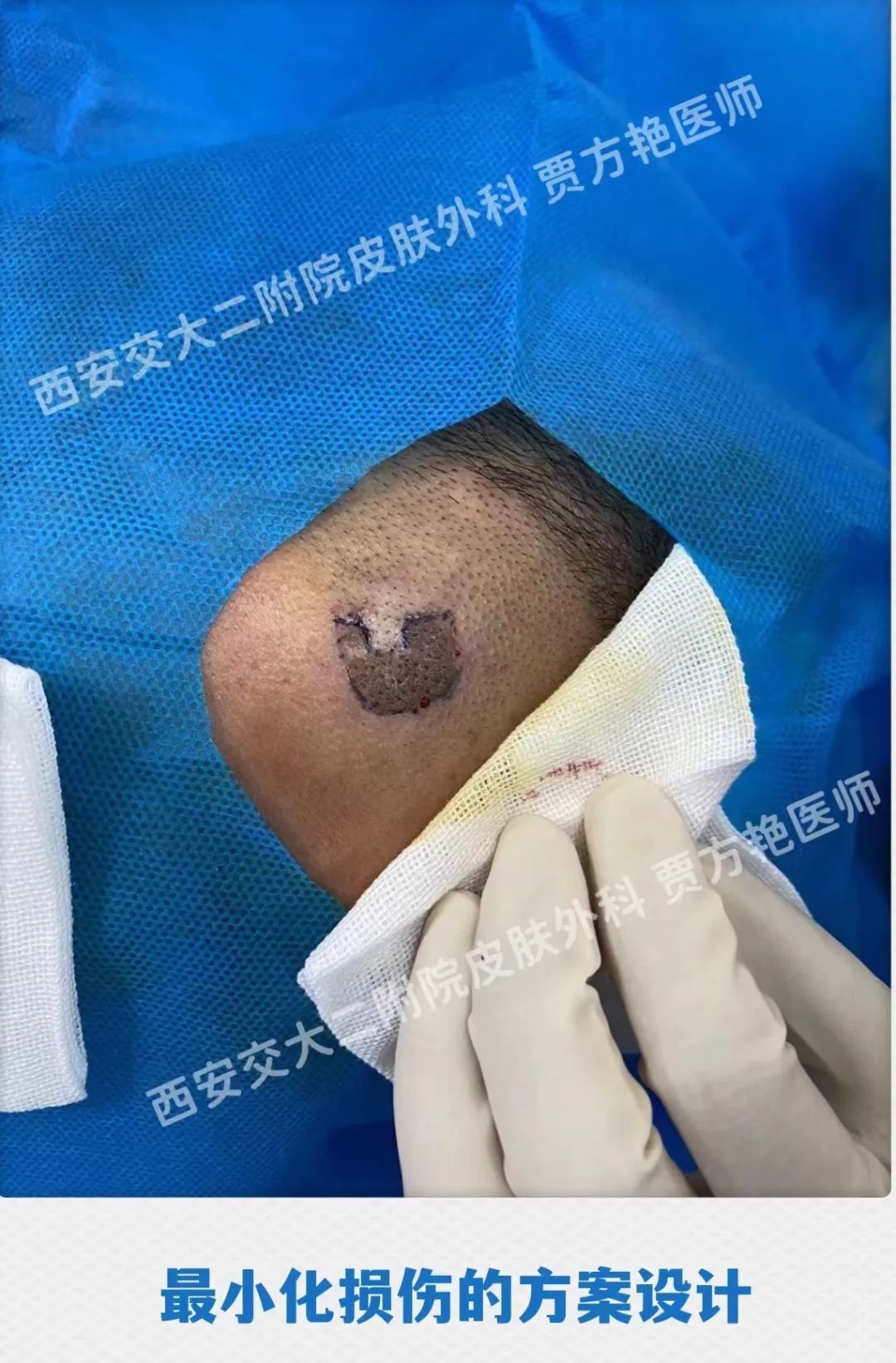 病例分享|局部皮瓣系列01:形状不规则的头皮及皮肤交界处脂溢性角化