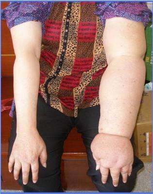 "肿"有办法——乳腺癌术后上肢淋巴水肿治疗经验分享