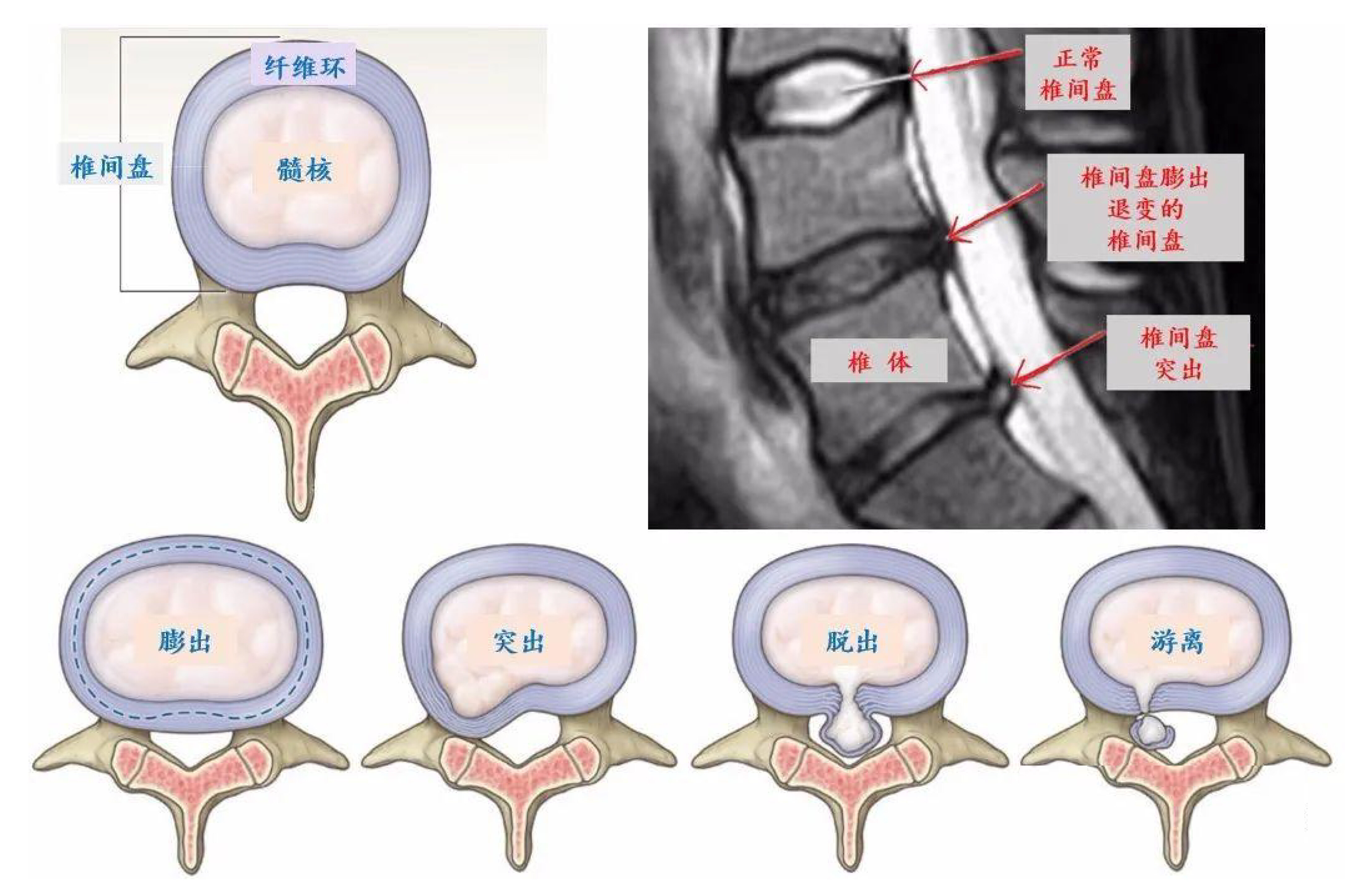 腰椎间盘突出病例变化jpg