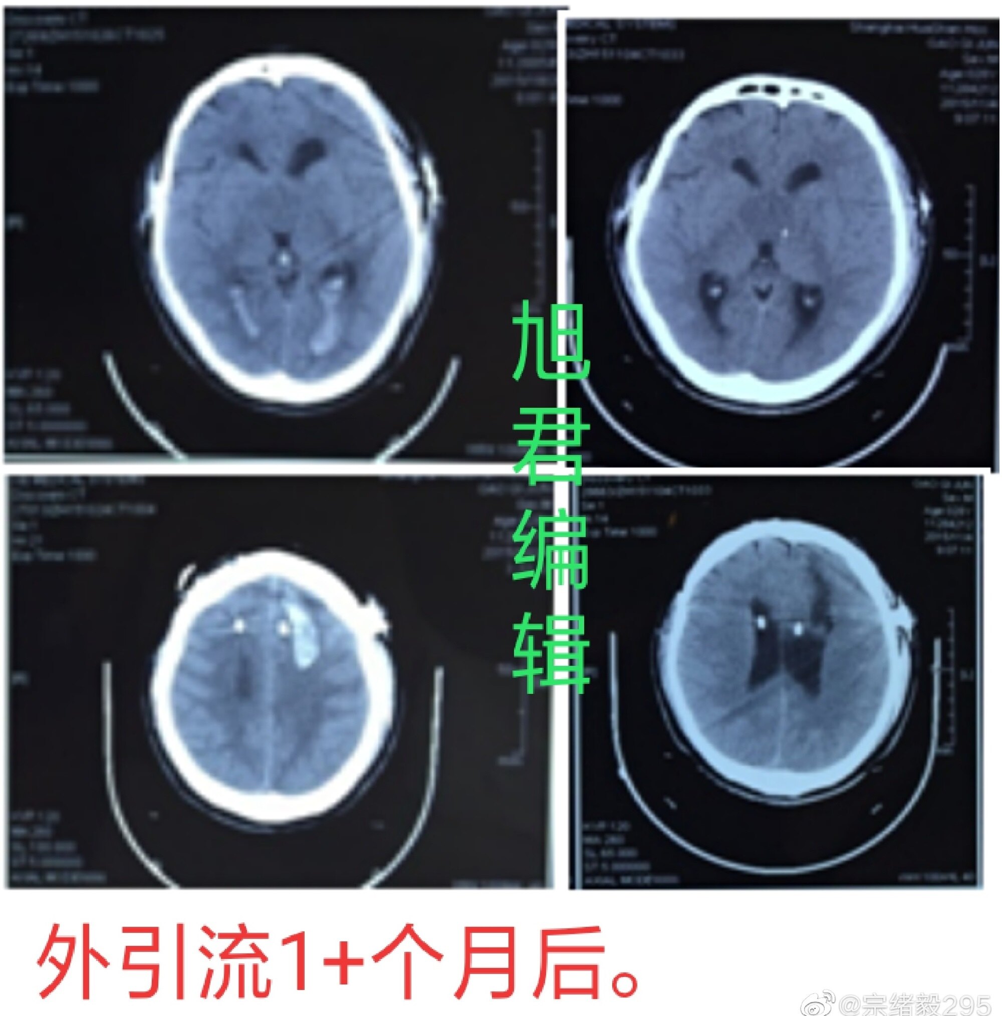 鞍上池囊肿的诊治