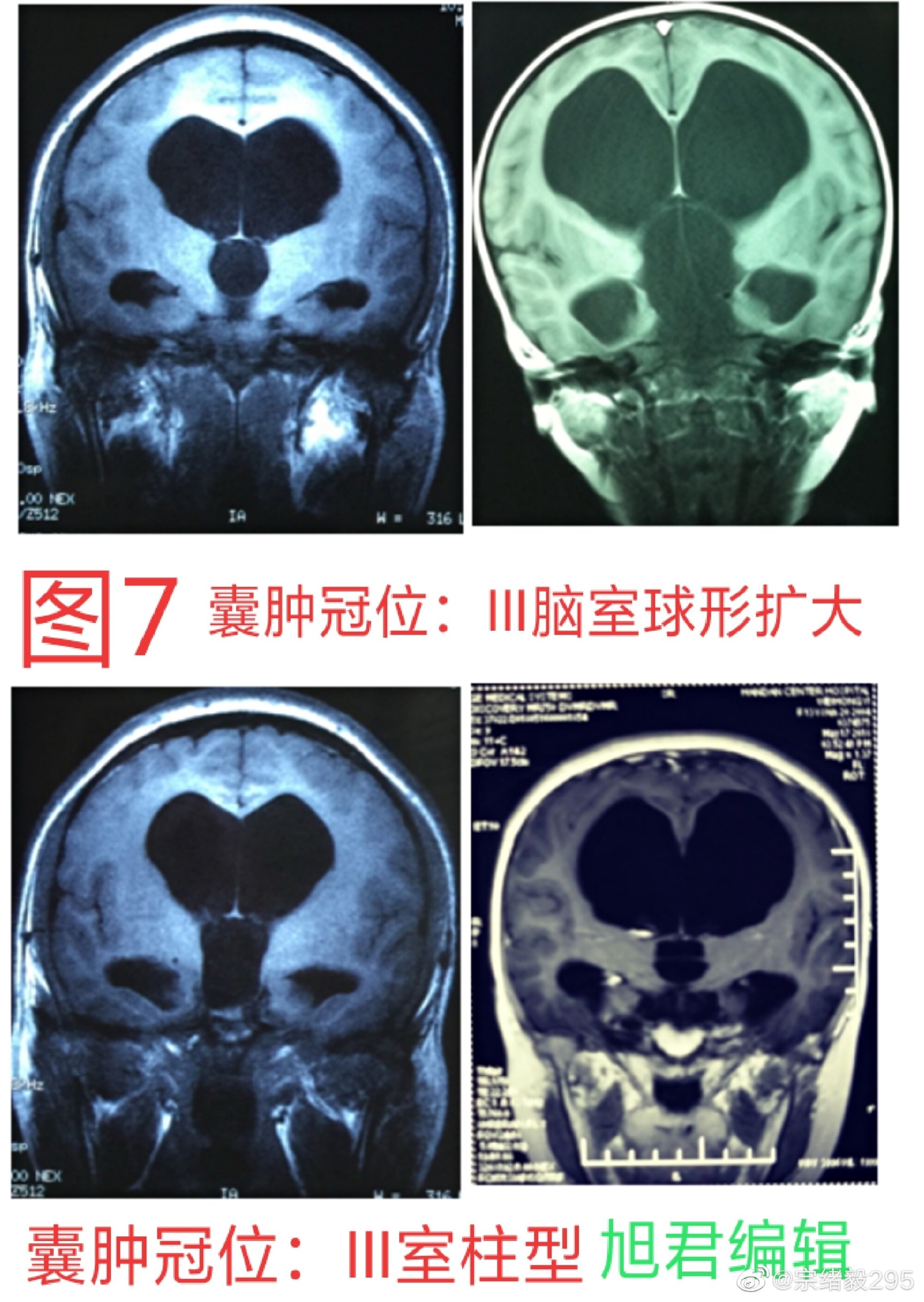 鞍上池囊肿的诊治