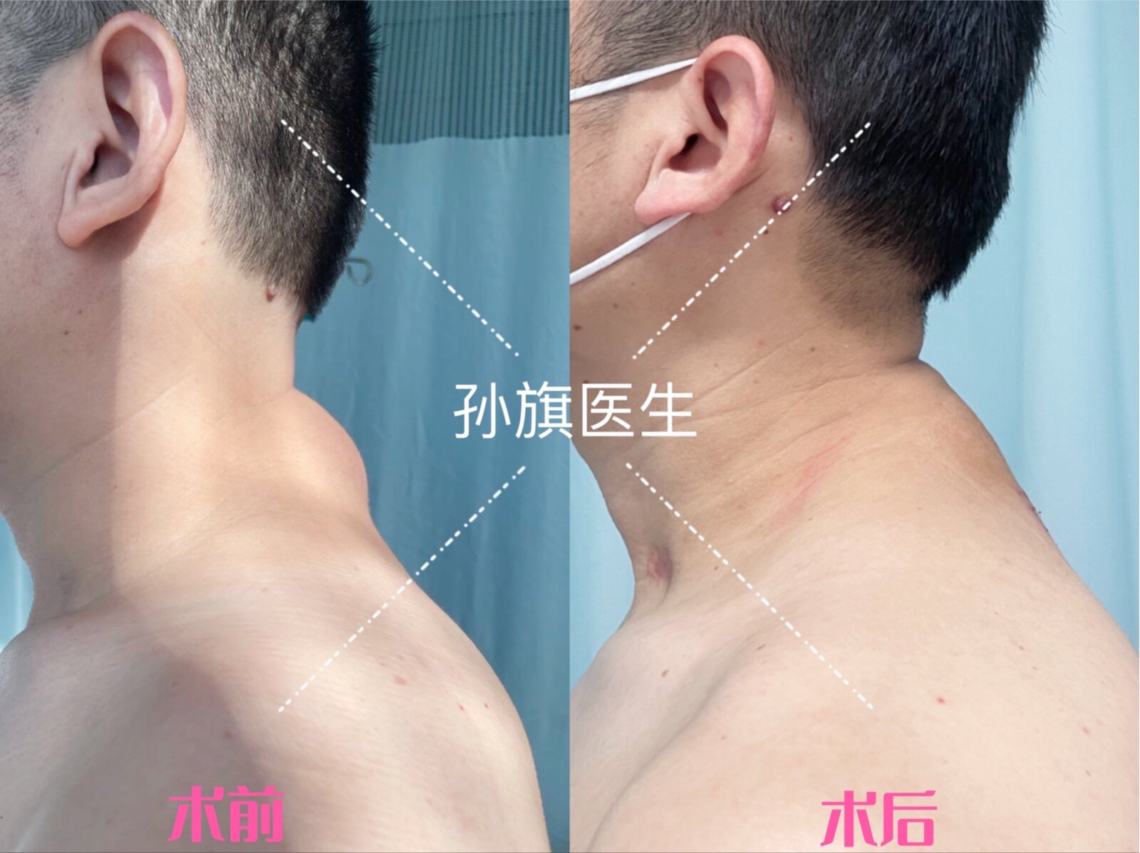 脂肪瘤_病因_症状_手术_发病原因_症状表现_治疗方式 - 好大夫在线