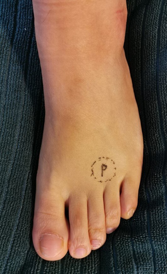 morton神经瘤症状主要是前足疼痛,最常位于3-4跖骨之间,患者感觉行走