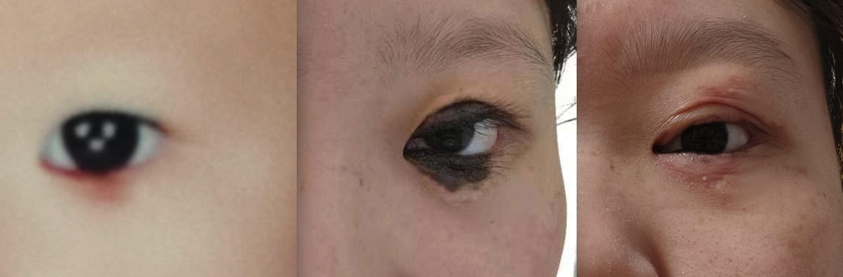 眼睑分裂痣植皮术后畸形修复