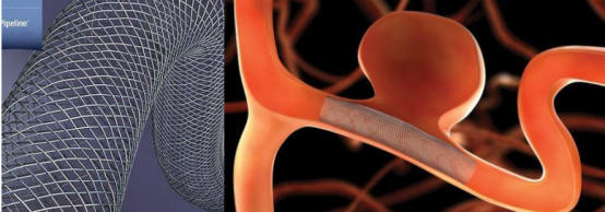 大脑中动脉m1段动脉瘤的pipeline治疗 - 好大夫在线