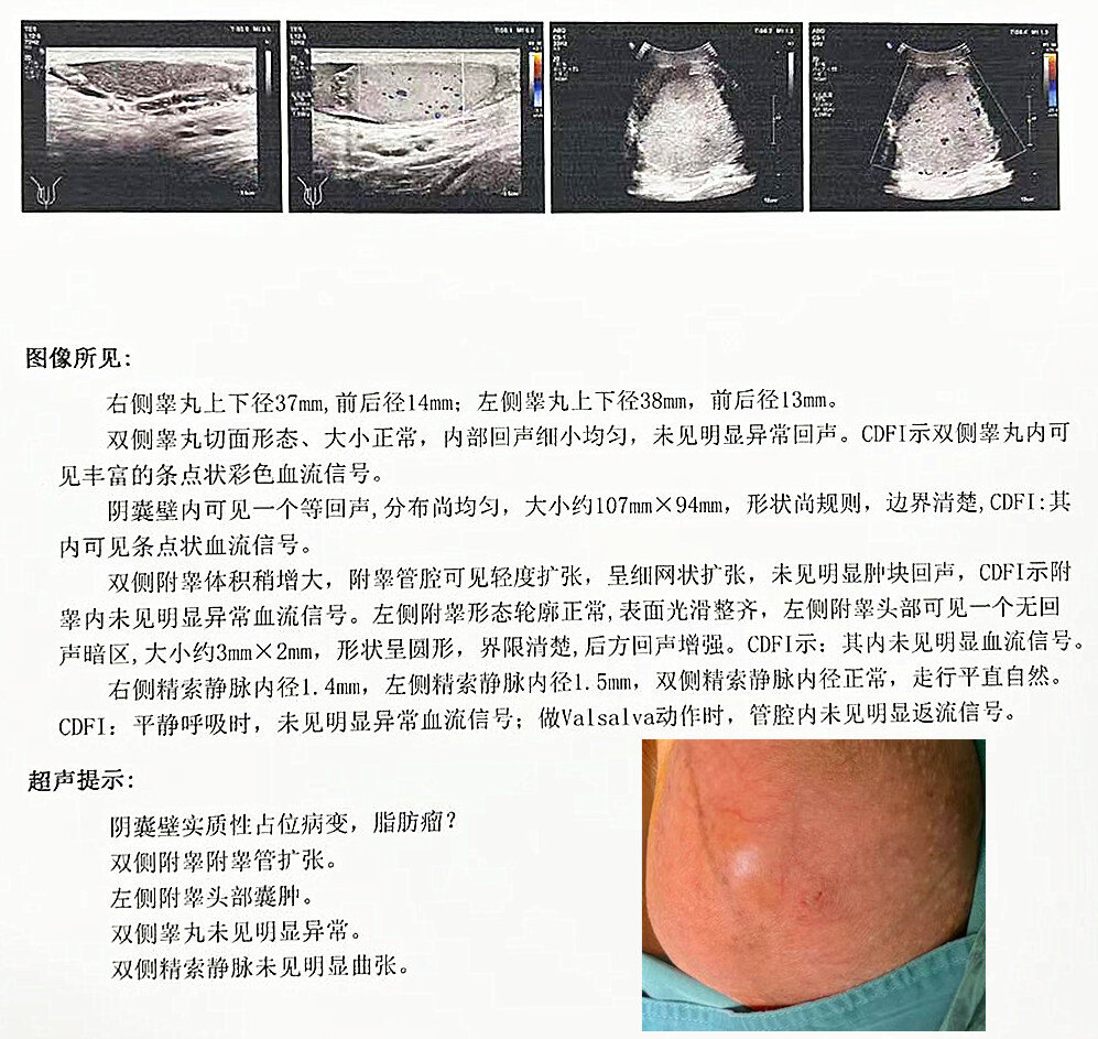 阴囊皮下脂肪瘤左侧附睾囊肿直径超过睾丸,临床上比较罕见,而且患者