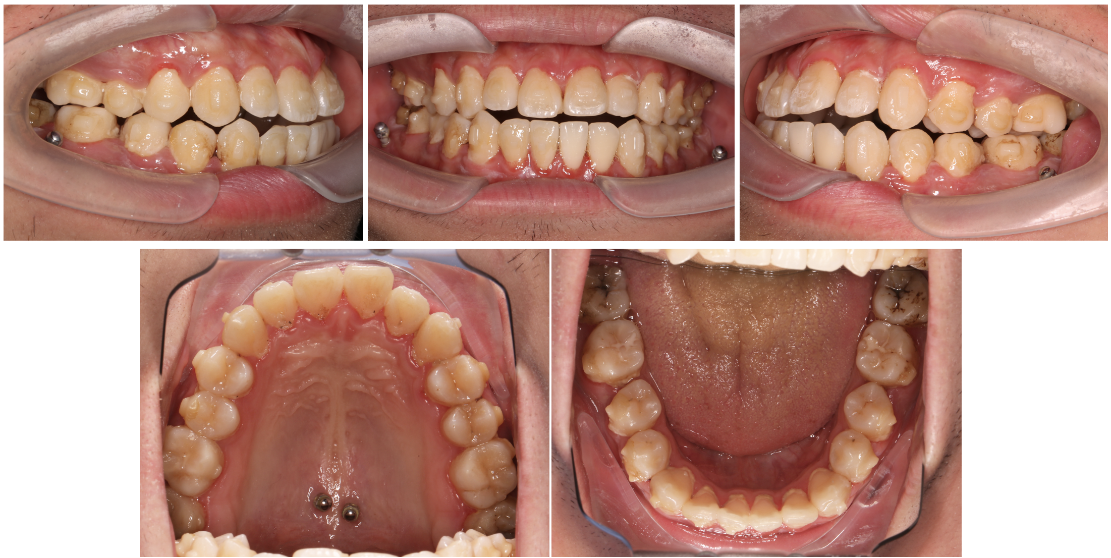 颞下颌关节骨关节病(tmjoa)相关前牙开合(aob)的正畸治疗方法 - 好大
