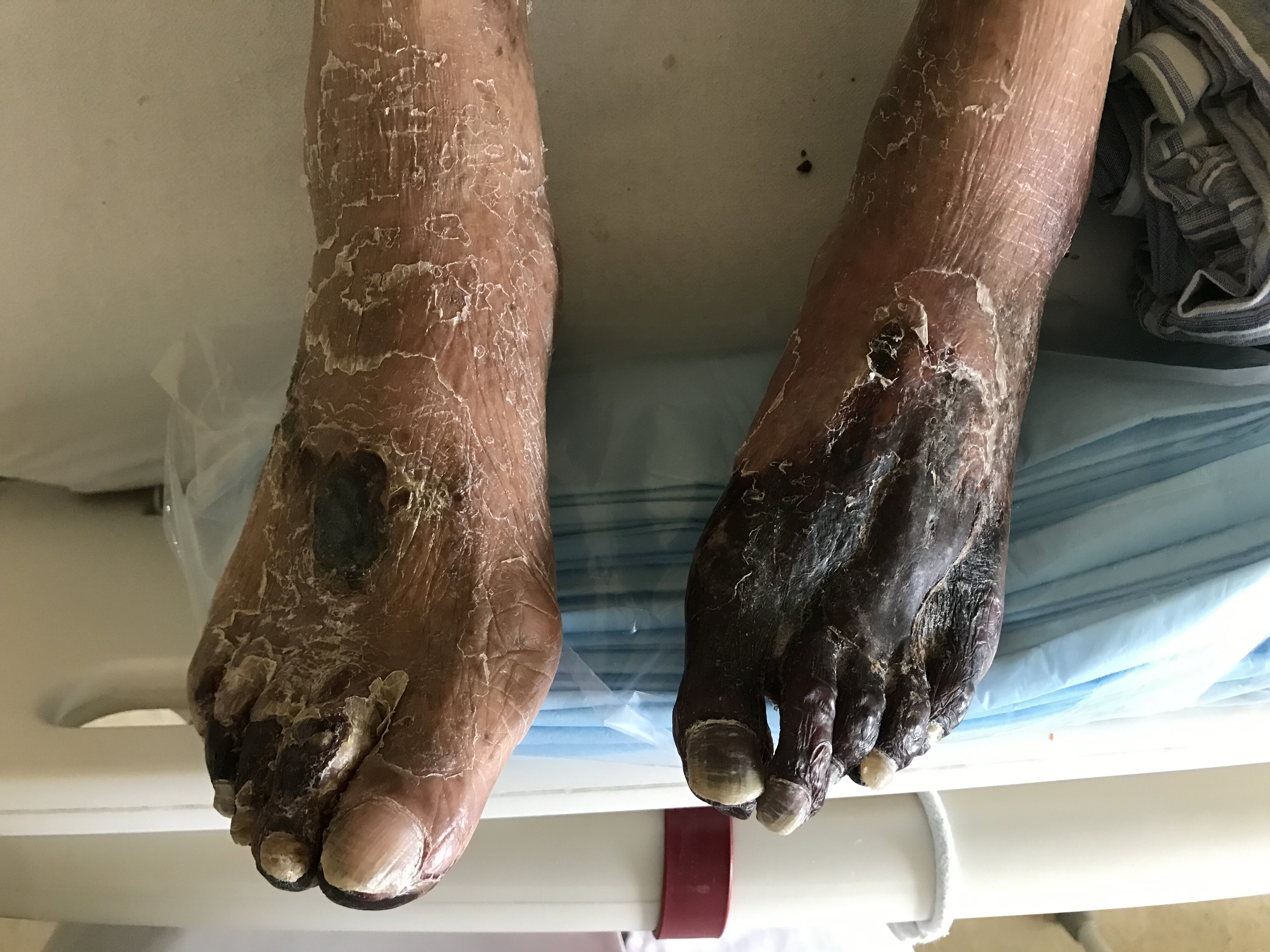 糖尿病周围神经病变的手术治疗_糖尿病神经病变_糖尿病神经病变治疗方