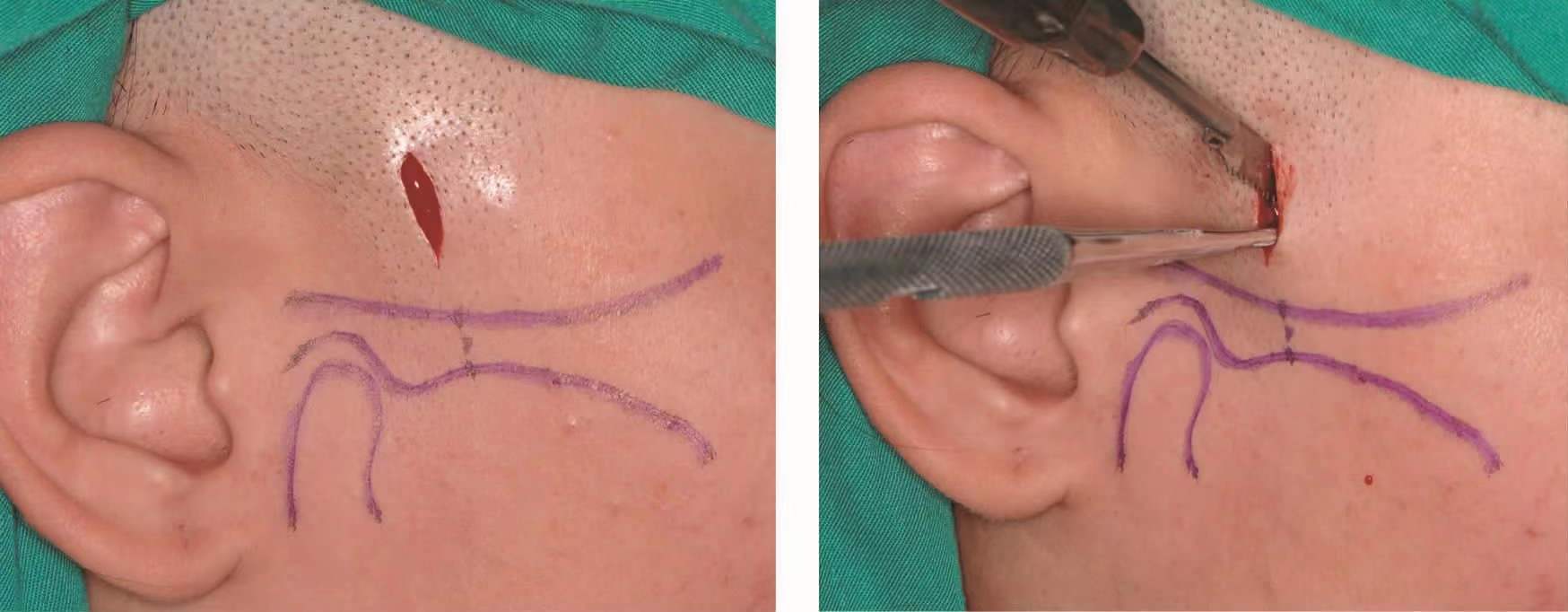 颧骨缩小术_下颌整形_下颌整形治疗介绍 - 好大夫在线