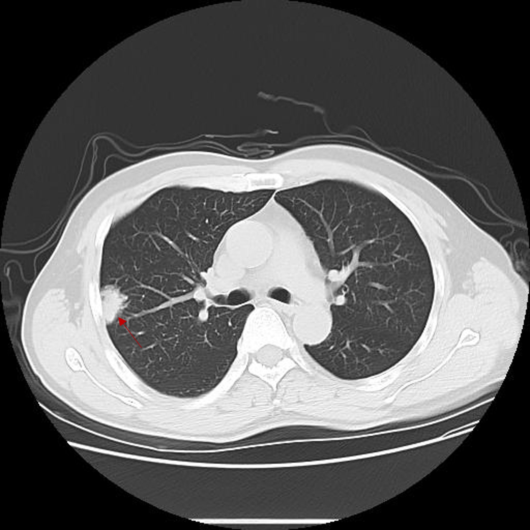 肺癌t2图片