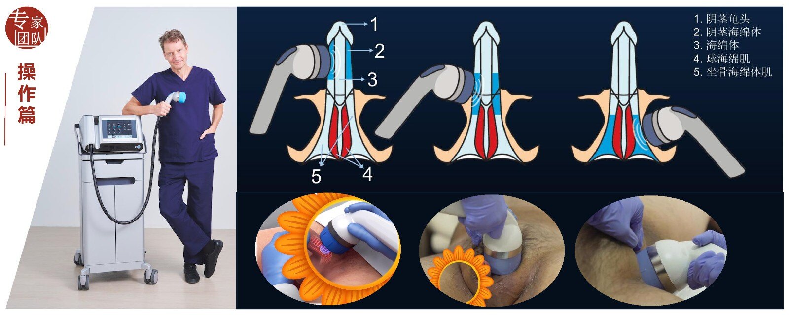 团队医师提醒:双管齐下疗效更好与"伟哥"相比,li-eswl治疗ed的优势是
