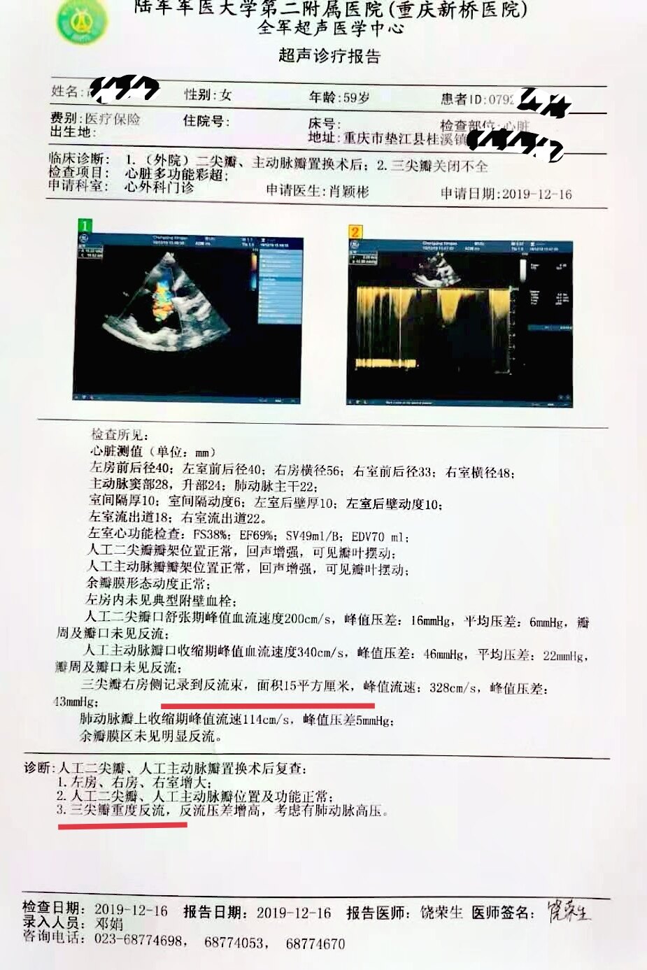 左心瓣膜(二尖瓣和/和或主动脉瓣)置换术后晚期出现三尖瓣的关闭全很