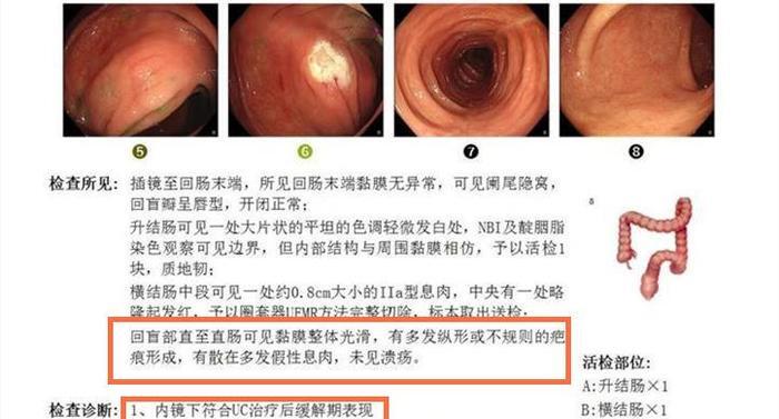 青玉散讓20年潰瘍性結腸炎老患者腸黏膜癒合